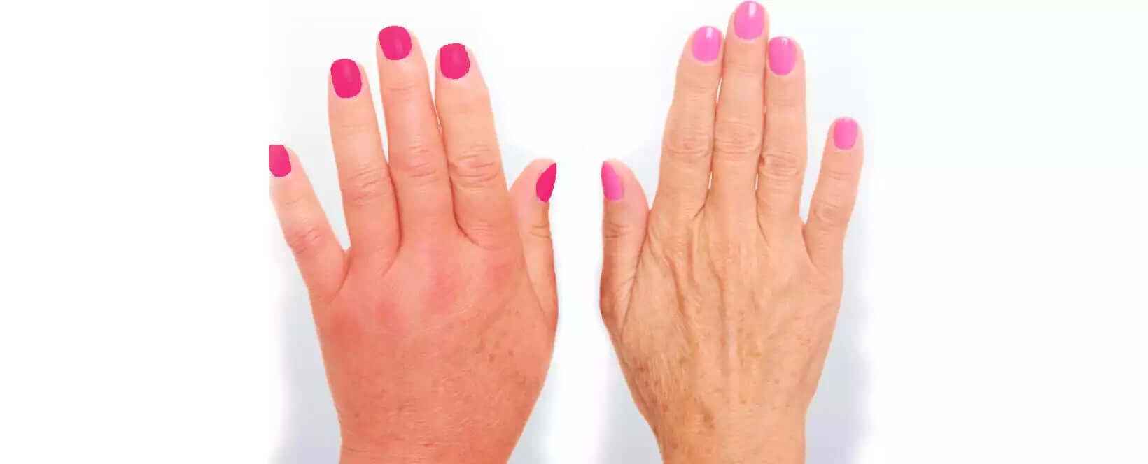 Descubre cómo Aliviar los Dolores de la Artritis Reumatoide: Conoce los Síntomas, Tratamientos y Prevención