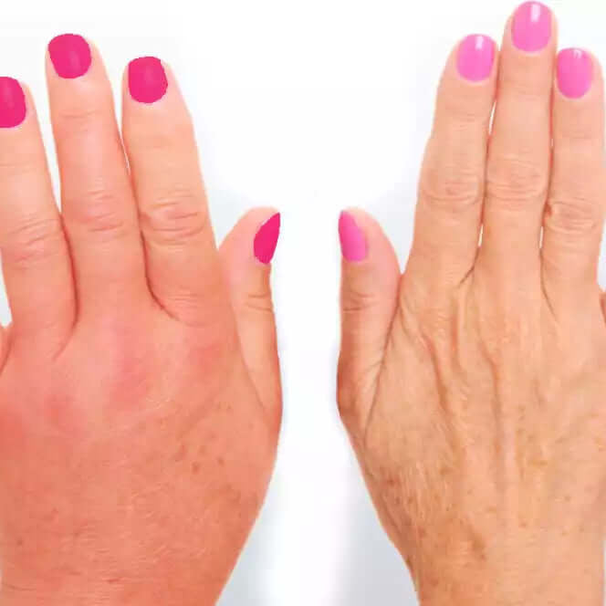 Descubre cómo Aliviar los Dolores de la Artritis Reumatoide: Conoce los Síntomas, Tratamientos y Prevención