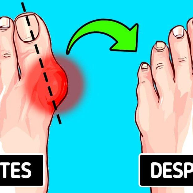 7 Métodos Efectivos para Tratar los Juanetes (Actualización 2025)